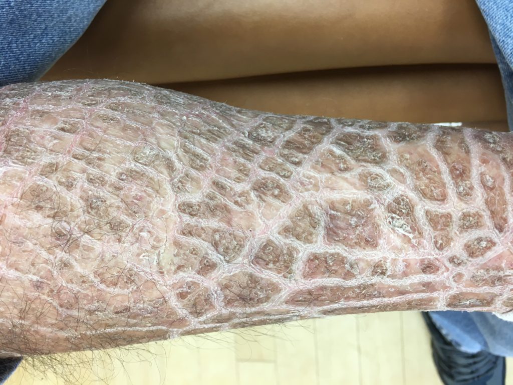 Ichthyosis – Appalachian Spring Dermatology