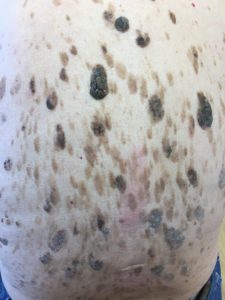 seborrheic keratoses growths dermatology ker seb