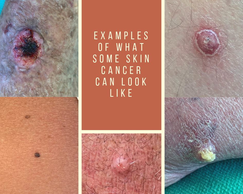 Examples Of What Some Skin Cancer Can Look Like Appalachian Spring Dermatology 