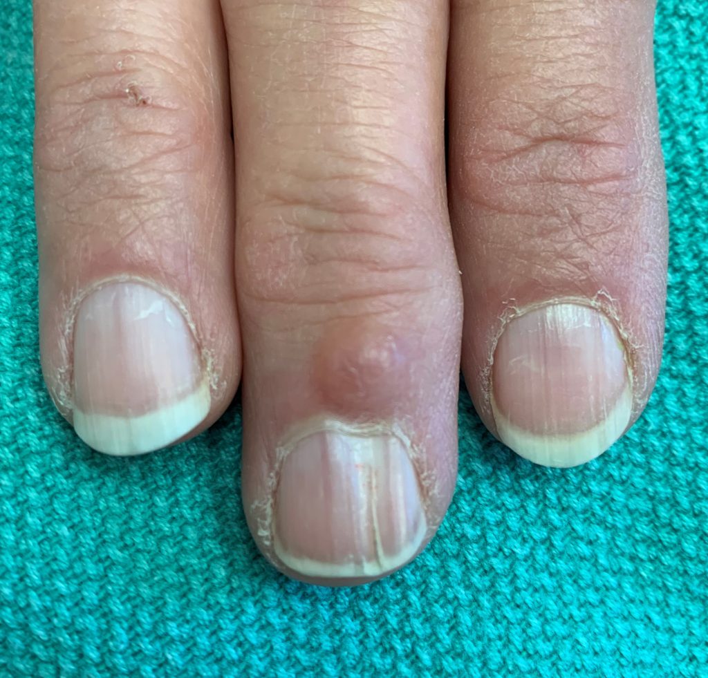 cancer-bumps-on-fingers