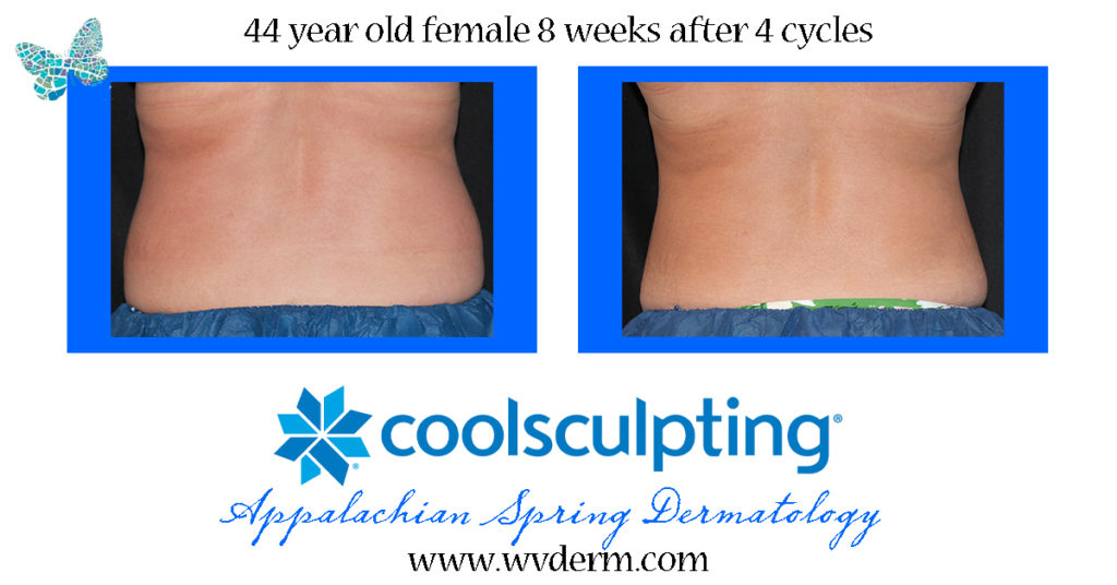 CoolSculpting® Bliss: Discover the Transformative Benefits of the