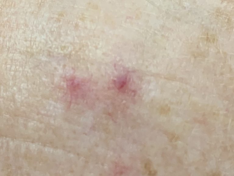 pinpoint red spots in skins