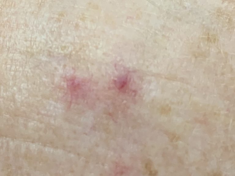 pinpoint sized red spots on skin