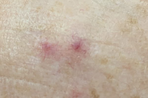 Should I be Worried About Red Dots on my Skin?