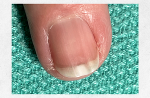 What causes these VERTICAL ridges in my fingernails? – Appalachian Spring  Dermatology